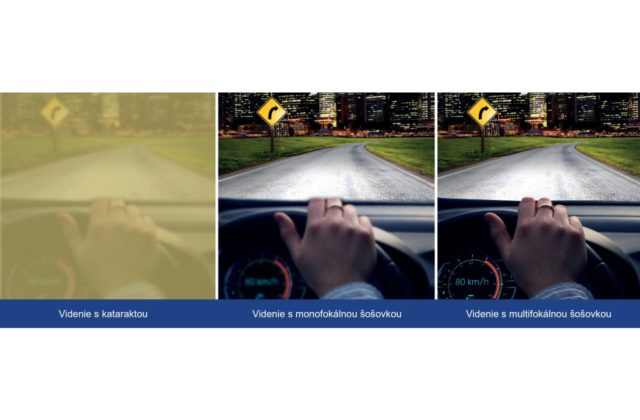 Inovácie v očnej chirurgii, dostupné aj na Slovensku